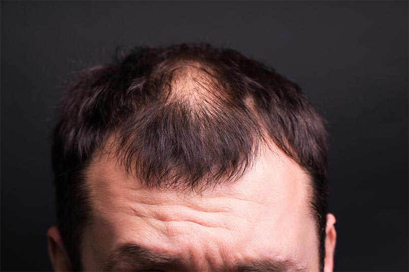 saç tedavileri ve saç dökülmesi