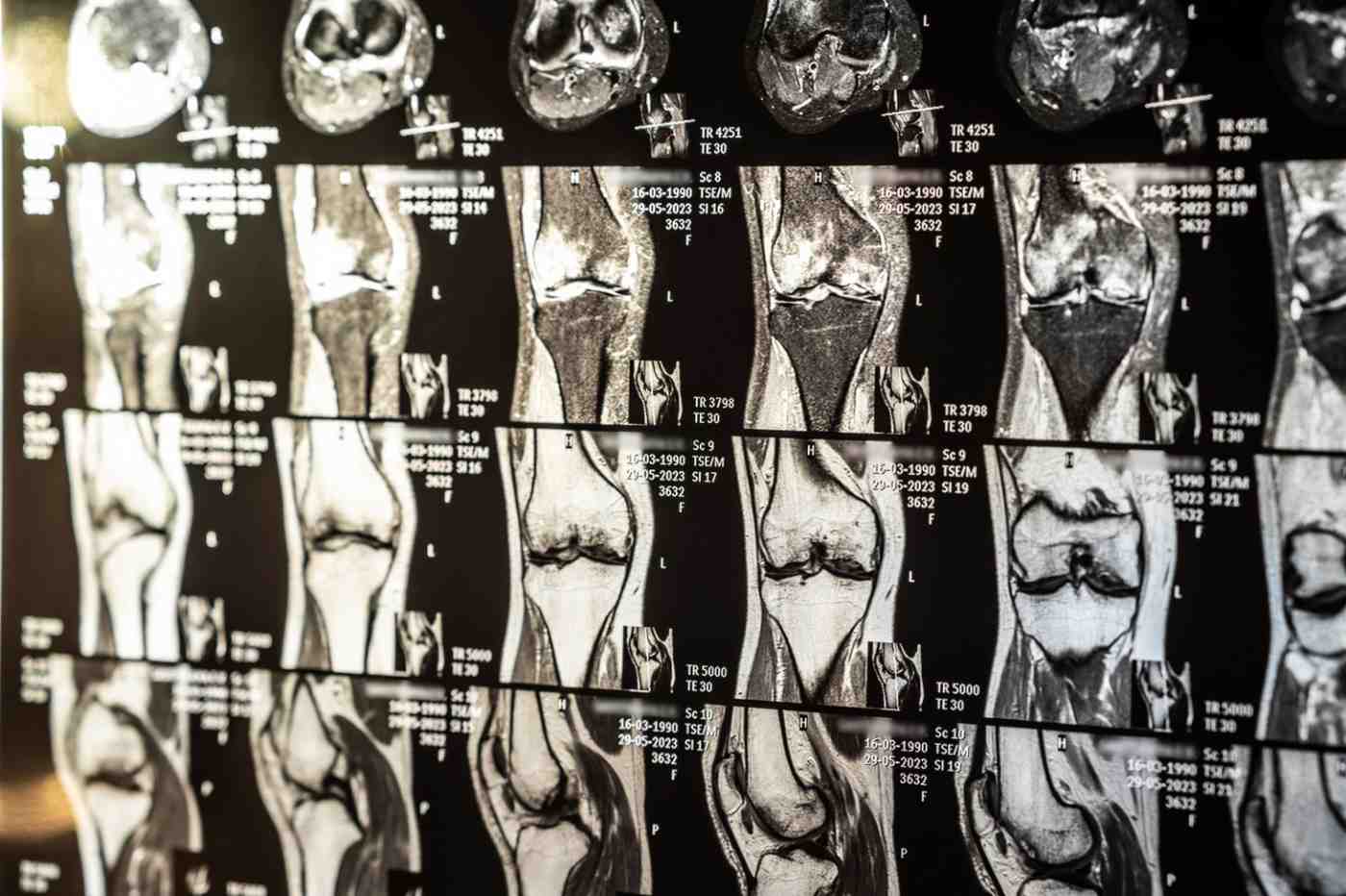 arthroscopic-surgery-mri